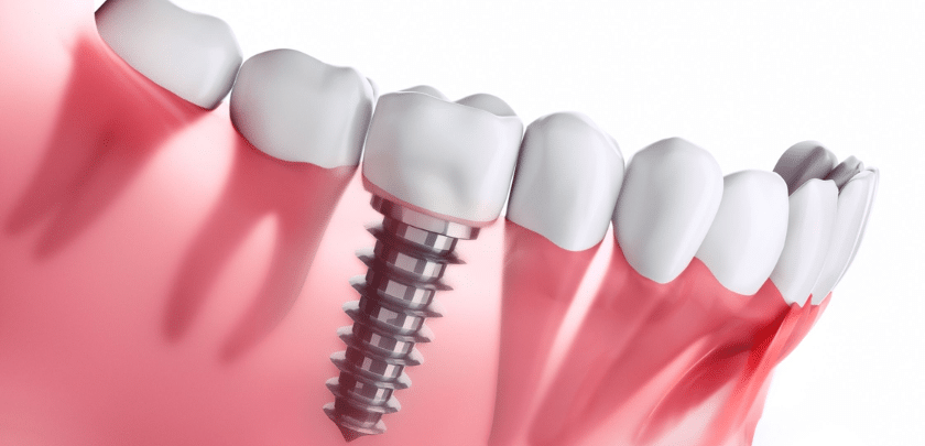 Dental-Implant