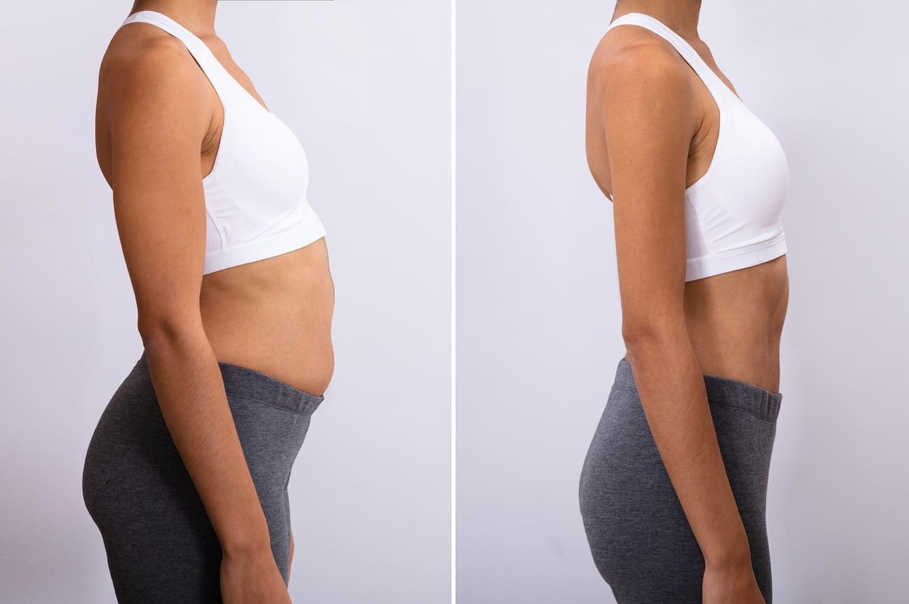 Vaser 4D Liposuction