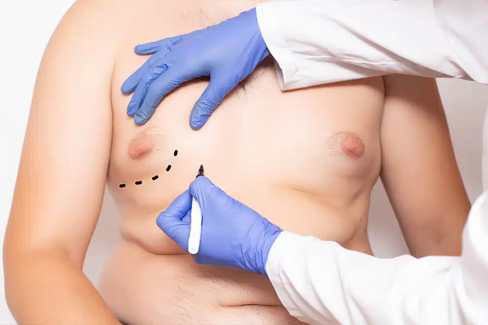 Gynecomastia Surgery Cost Dubai